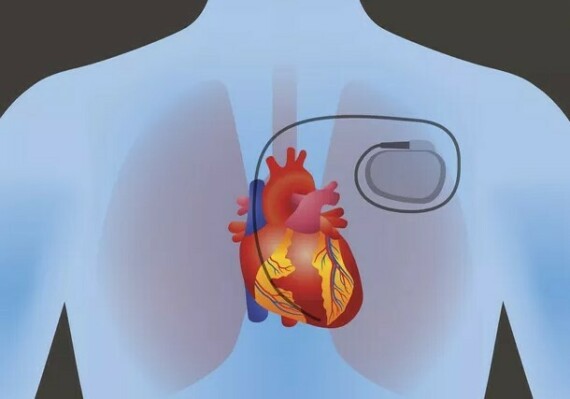 Bác sĩ có thể chỉ định đặt máy tạo nhịp tim nhân tạo để giữ cho tim duy trì hoạt động  (Nguồn ảnh: iStock photo)