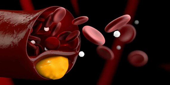 Tăng cholesterol máu có tính gia đình, bệnh lý di truyền phổ biến nhất thế  giới | Vinmec