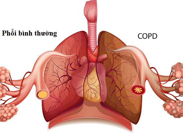 Tổn thương phổi trong COPD. Nguồn ảnh: residentialhealthcaregroup