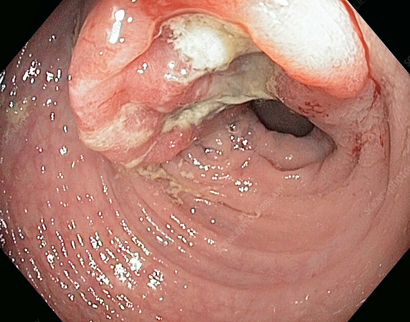 Nội soi tiêu hóa thấy khối u sùi loét ở đại tràng. Nguồn ảnh: sciencephoto.com