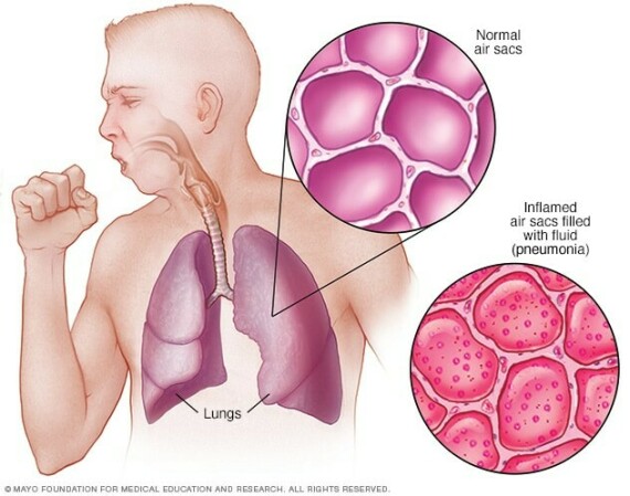 Viêm phổi gây tụ dịch trong các phế nang. Nguồn ảnh mayoclinic.org