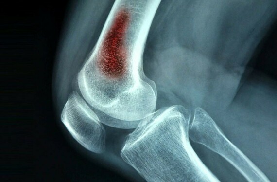 Viêm tủy xương do nấm trên phim X-quang. Nguồn ảnh: Pinterest