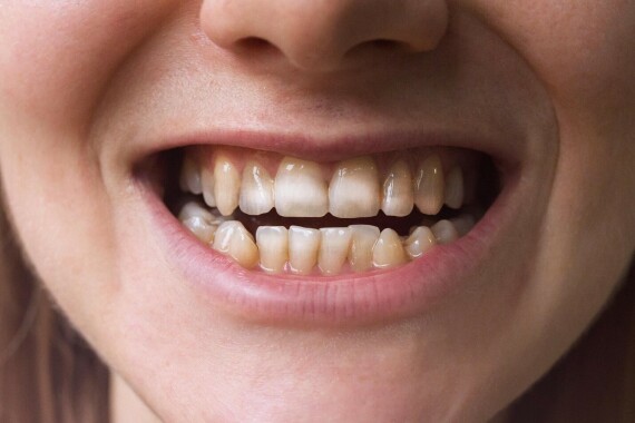 Khiếm khuyết về men răng của bệnh nhân Celiac (nguồn ảnh: https://www.rd.com/)