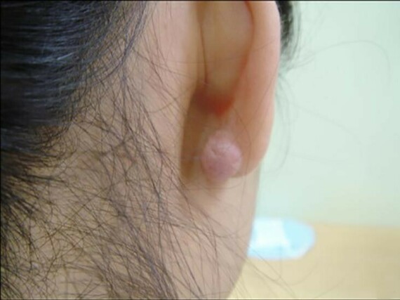 Sẹo lồi ở tai có thể giống mụn. Nguồn ảnh: medicalnewstoday