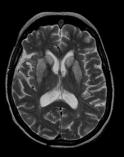Hình ảnh thiếu oxy lên não trên MRI. Nguồn ảnh: https://www.pinterest.com