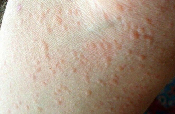 Dị ứng thời tiết: Bệnh ngoài da phổ biến nhiều người mắc phảiSử dụng thuốc cũng có thể gây kích ứng tại chỗ.