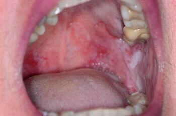 Pemphigus vulgaris ở miệng