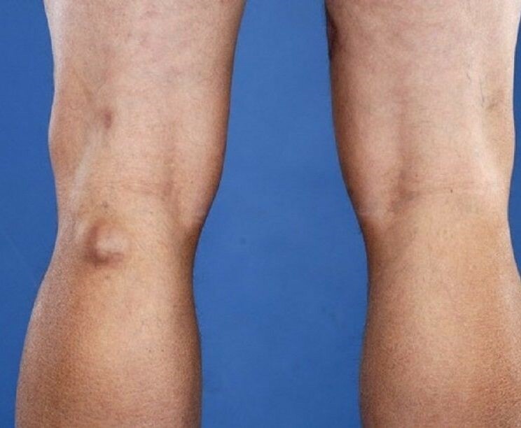 Hình ảnh kén Baker ở sau đầu gối. Nguồn ảnh: https://www.thefootandankleclinic.com.au.