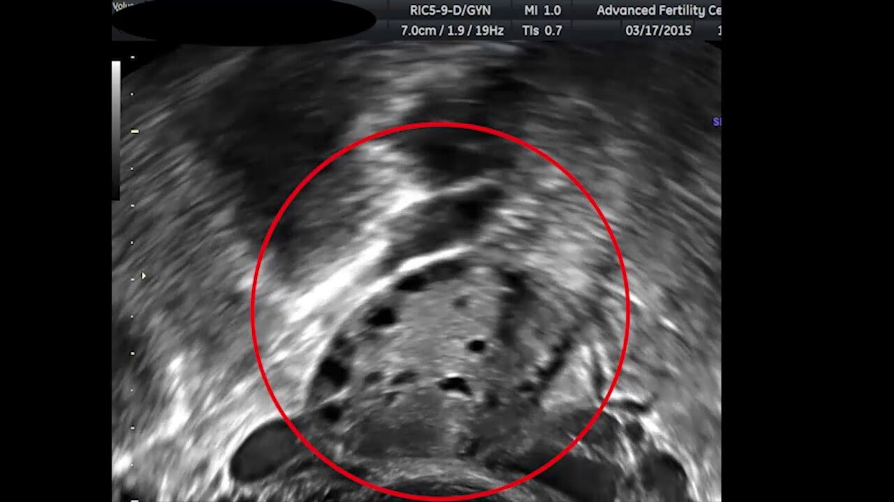 Đếm số lượng nang trứng có hốc qua siêu âm. Nguồn ảnh: advancedfertility.com
