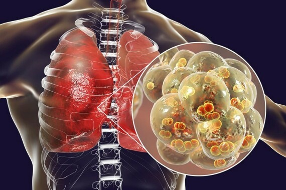 Bảo Phế Vương hỗ trợ cải thiện các triệu chứng của viêm phổi