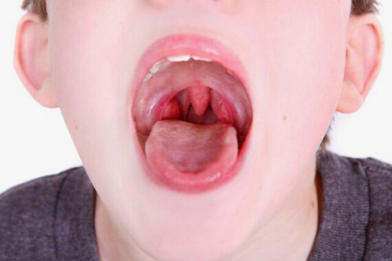 Thuốc có thể gây dị ứng nghiêm trong với biểu hiện ngứa sưng, họng