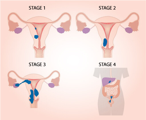 Các giai đoạn của ung thư tử cung. Nguồn ảnh: wci.co.in