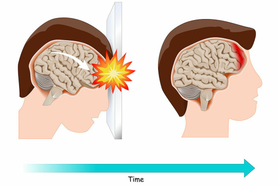 Chấn thương sọ não có thể gây ra hôn mê, nguồn ảnh omtrial.com