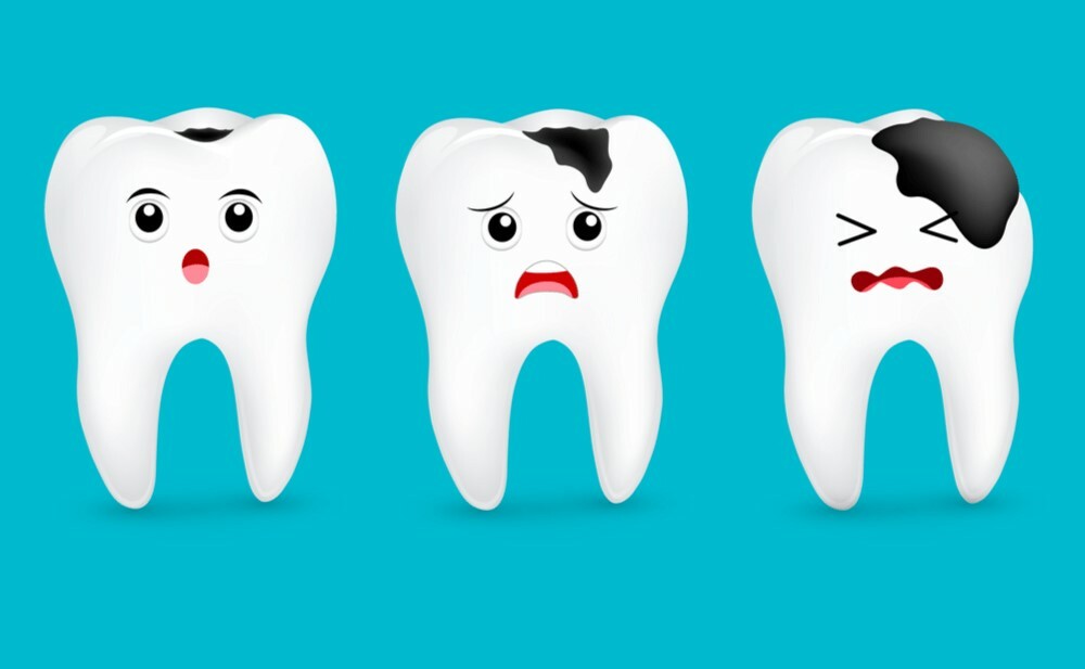 Ê buốt răng kéo dài không được điều trị có thể làm phá hủy men răng dẫn đến sâu răng.  Nguồn ảnh: barodadental.com