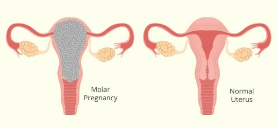 Hình ảnh tử cung bình thường (bên phải). Hình ảnh thai trứng (bên trái) với những đám mô phát triển bất thương thành hình chùm nho (hình trứng ếch) (nguồn ảnh: https://www.momjunction.com/)