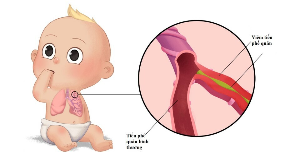 Viêm tiểu phế quản do RSV. Nguồn ảnh: health&