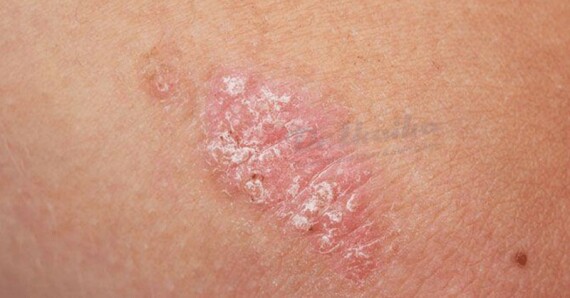 Nấm Candida có thể lây nhiễm sang da và niêm mạc. Nguồn ảnh: fungusfactfriday.com