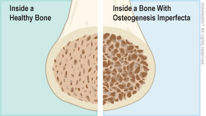 So sánh bên trong xương bình thường (bên trái) và xương thủy tinh (bên phải). Nguồn ảnh kidshealth.org