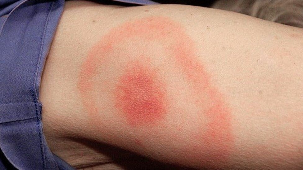 Vết cắn trong bệnh lyme do bọ ve gây ra, có thể gây nhiễm trùng do toàn thân do vi khuẩn Borrelia burgdorfer. Nguồn ảnh bbc.com