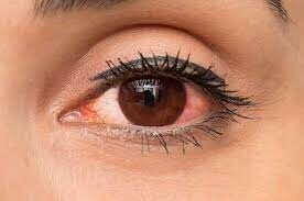Thuốc hỗ trợ điều trị các bệnh lý nhiễm trùng mắt