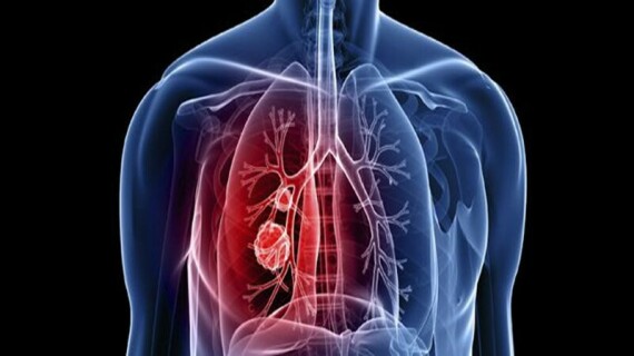 Bosentan được chỉ định trong điều trị tăng áp động mạch phổi