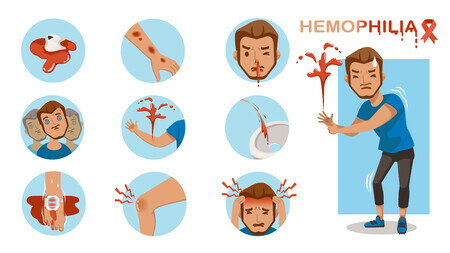 Các vị trí có thể gặp chảy máu ở người mắc hemophilia. Nguồn ảnh 123rf.com
