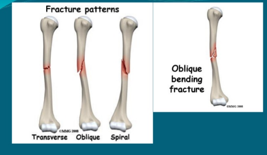 Gãy thân xương cánh tayThuốc được sử dụng để giảm đau do gãy xương.