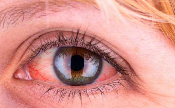 Thuốc có thể gây ra cảm giác nóng và đỏ mắt sau khi nhỏ thuốc