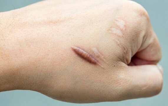 Contractubex thường dùng để điều trị sẹo lồi