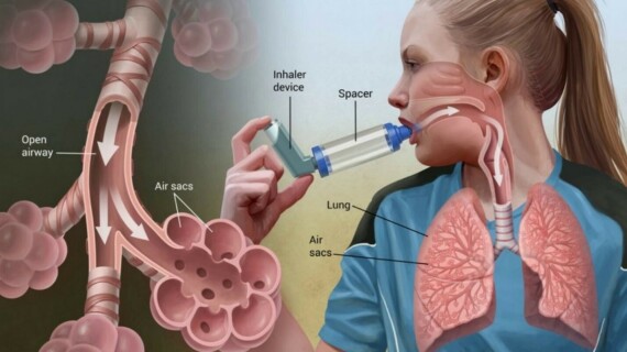 Thuốc Formoterol thường được dùng ngăn ngừa hoặc giảm chứng thở khò khè và khó thở do hen suyễn hoặc bệnh phổi tắc nghẽn mạn tính