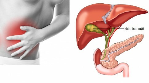 Ursodeoxycholic Acid thường dùng để điều trị sỏi túi mật