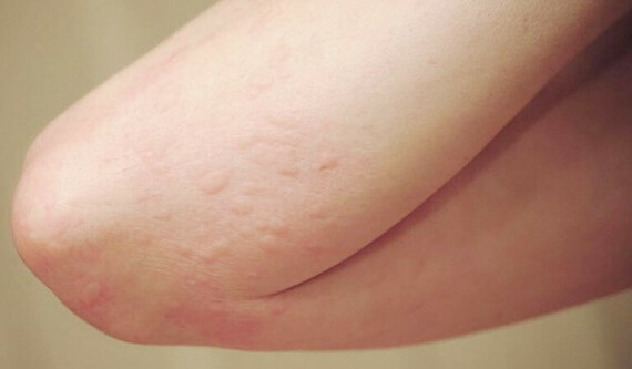 Các loại dị ứng da thường gặp và cách xử lý nhanhDị ứng ngoài da là một trong các tác dụng phụ của thuốc
