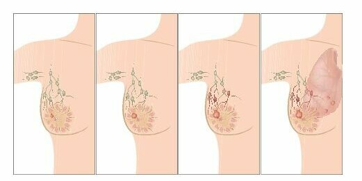 Ung thư vú - Bệnh Viện FVFaslodex thường dùng để điều trị ung thư vú