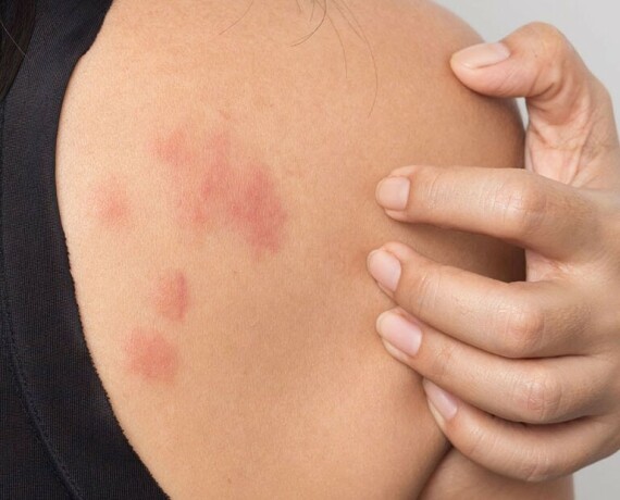 Một số trường hợp bị nổi ban đỏ trên da do dùng thuốc Donapu