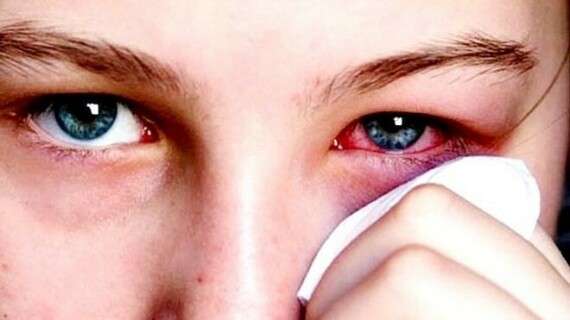 Blephamide được chỉ định trong điều trị viêm mắt và mí mắt có nhiễm trùng