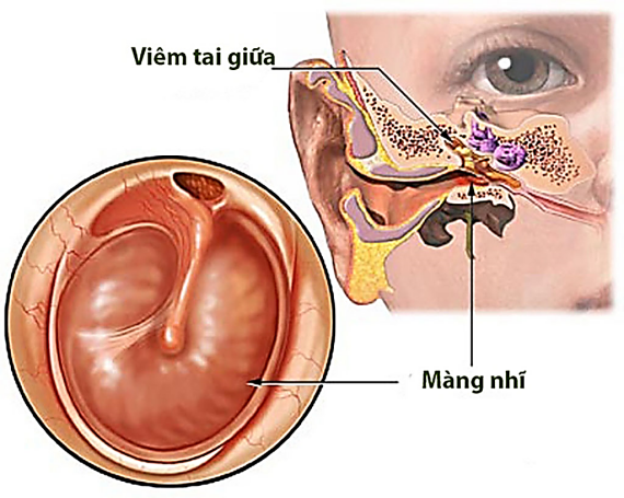 Bệnh Viêm Tai Giữa là gì, cách phòng ngừa và điều trị | Taimuihongsg.comCefpodoxim là thuốc điều trị viêm tai giữa