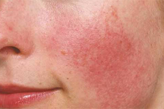 Lý giải tình trạng da mặt bị đỏ rát và ngứa | TCI HospitalTình trạng nóng rát do quá mẫn với thuốc.