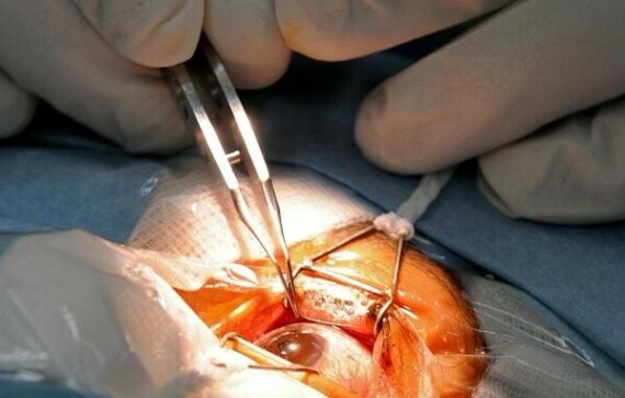 Phẫu thuật đục thủy tinh thể: Cần chuẩn bị những gì?Sử dụng trong phẫu thuật đục thuỷ tinh thể.