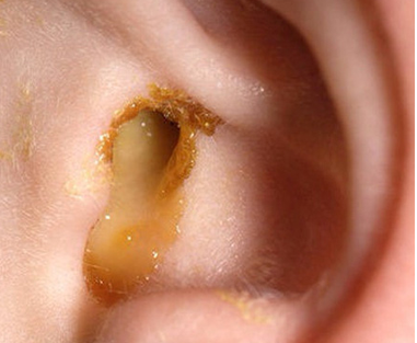 Dobixime thường được dùng để điều trị viêm tai giữa cấp