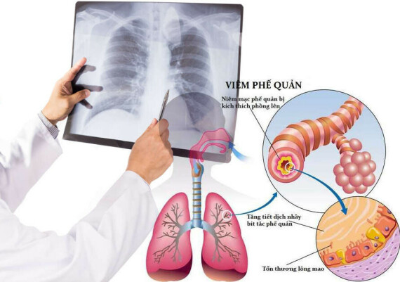 Thuốc được chỉ định trong các trường hợp viêm phổi.