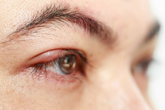 Bacitracin thường dùng để điều trị nhiễm khuẩn mắt như: chắp, viêm mi và viêm bờ mi