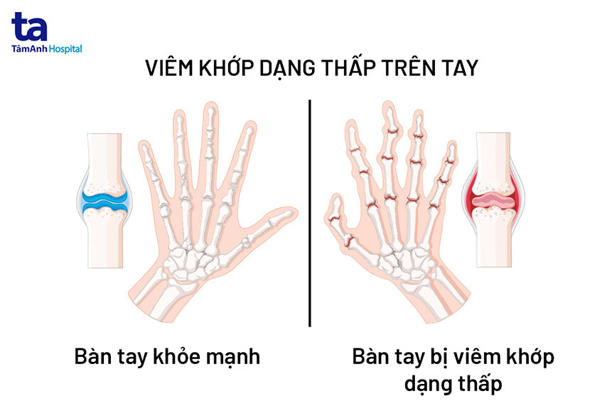 Thuốc được chỉ định giảm đau trong điều trị viêm khớp dạng thấpThuốc được chỉ định giảm đau trong điều trị viêm khớp dạng thấp