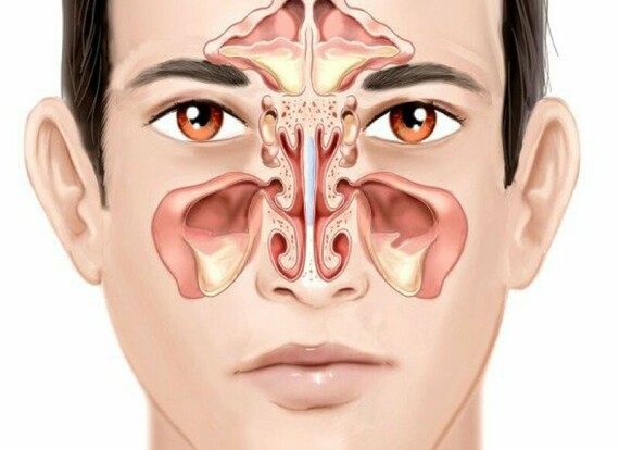 Bromelain 500mg giúp giảm sưng ở vùng mũi và xoang sau phẫu thuật hoặc chấn thương