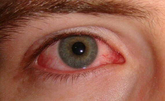 Pink_eye-600x369-1.jpgHãy gọi ngay cho bác sĩ nếu bạn gặp phải tác dụng phụ đỏ mắt