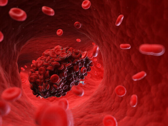 DuoPlavin giúp đề phòng sự hình thành cục máu đông