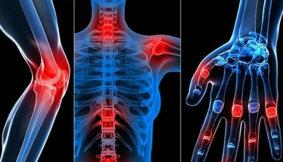 Alendronate có thể gây đau khớp, đau lưng
