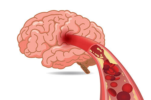 Ginkgo thường được dùng để hỗ trợ tăng tuần hoàn não