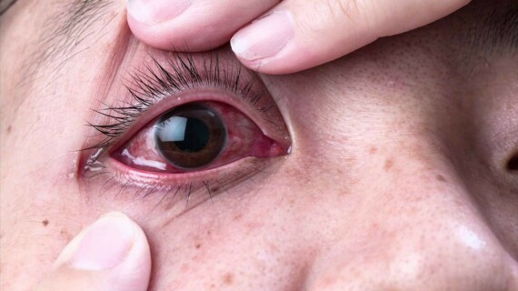 Đỏ mắt là tác dụng phụ có thể gặp khi dùng thuốc