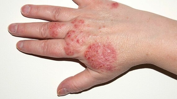 Thuốc được dùng để điều trị bệnh da eczema