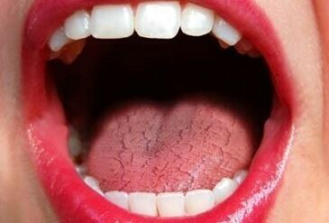 Khô miệng là tác dụng phụ có thể gặp khi dùng thuốc